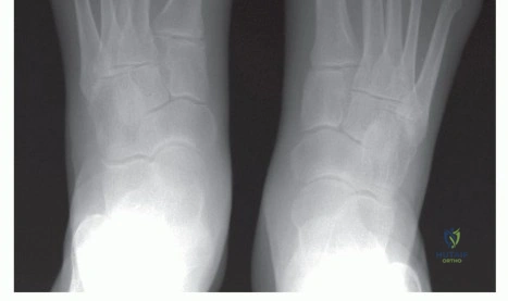 Triplanar Osteotomy and Lateral Ligament Reconstruction: Comprehensive Surgical Guide