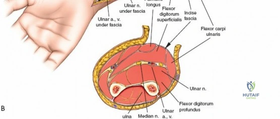 Two-Incision Technique for Anterior Cruciate Ligament Reconstruction Using Bone-Patellar Tendon-Bone Graft