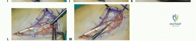 Two-Stage Flexor Tendon Graft for Flexor Pollicis Longus: The Hunter Technique