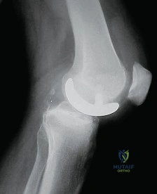 صورة طبية: جراحة استبدال مفصل الركبة الجزئي (UKA): تجنب الأخطاء والاستفادة القصوى في صنعاء مع الأستاذ الدكتور محمد هطيف