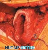 Illustration of uncemented total hip - Dr. Mohammed Hutaif