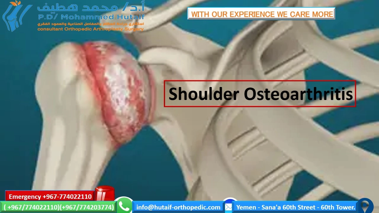 Shoulder osteoarthritis-Summary