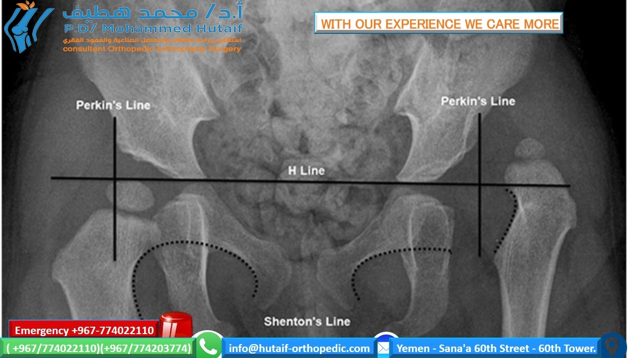 Hip Dysplasia-IMAGING AND OTHER DIAGNOSTIC STUDIES