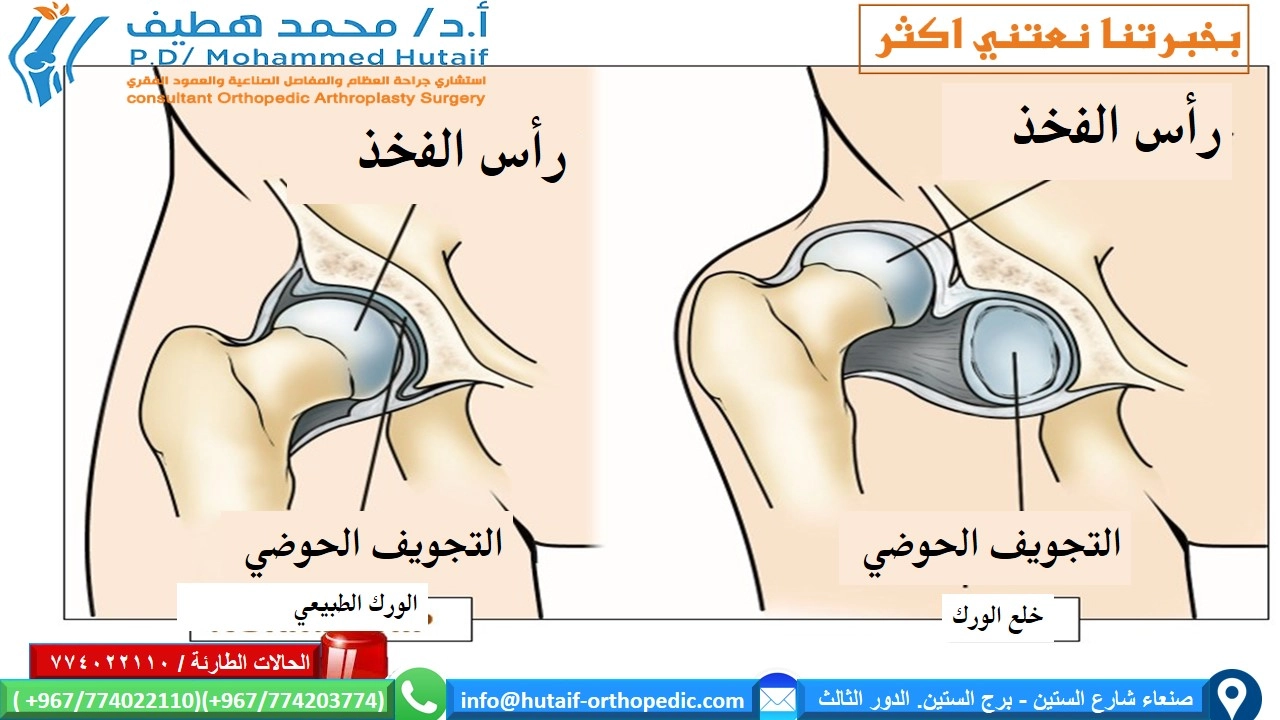 خلع الورك الولادي -ملخص -المسار المعتاد لتطور المرض 