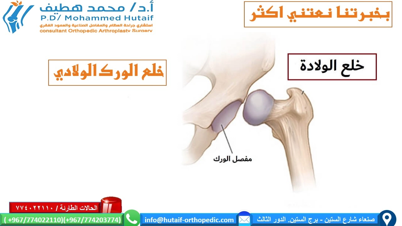 خلع الورك الولادي (DDH) - الأسباب - عوامل الخطر