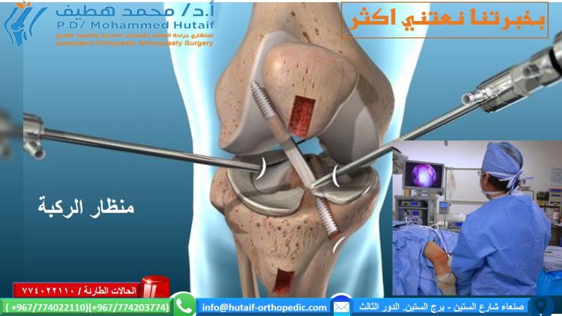 إجراءات تنظير الركبة-منظار الركبة