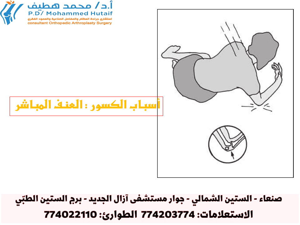 أسباب الكسور : العنف المباشر :