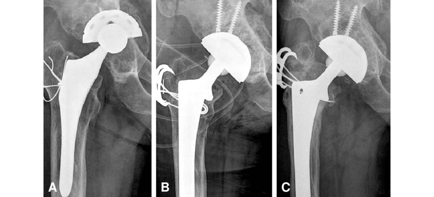 Techniques to Manage Osteolysis Around Well-Fixed Acetabular Components