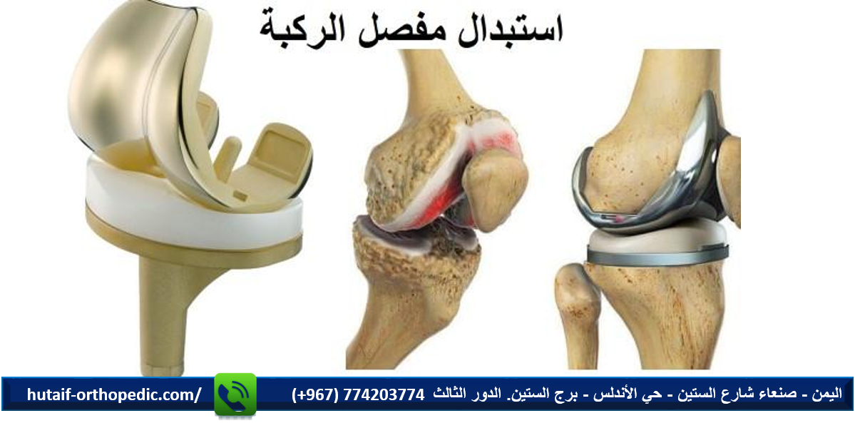 تكلفة تغيير مفصل الركبة في اليمن والدول العربية والعالمية: دراسة مقارنة