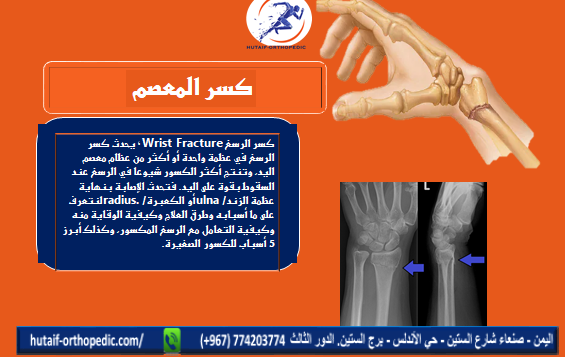 كسر الرسغ