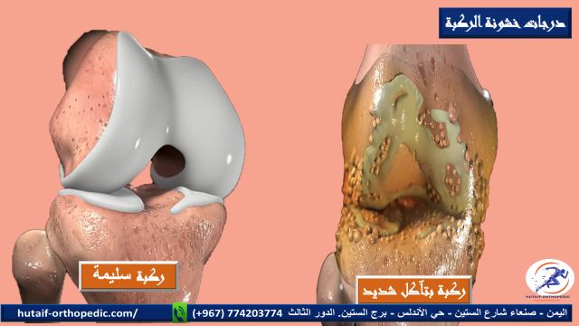 درجات خشونة الركبة 