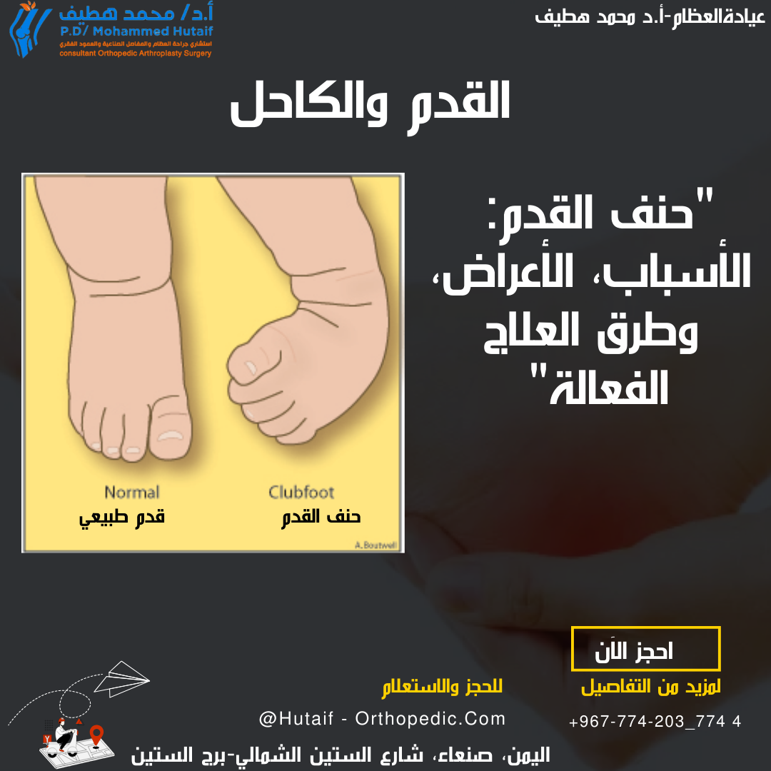 "حنف القدم: الأسباب، الأعراض، وطرق العلاج الفعالة"