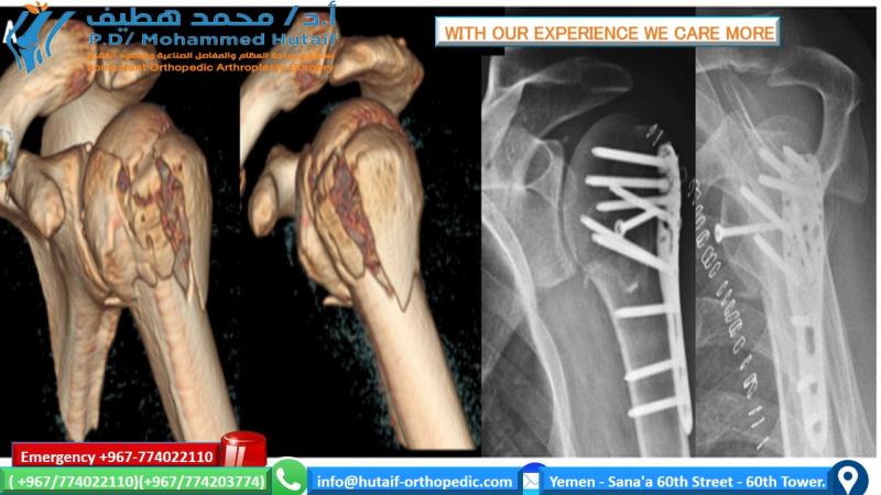 Proximal Humeral fractures Clinical And Radiographic Assessment Of Patients With Suspected Proximal Humeral Fractures
