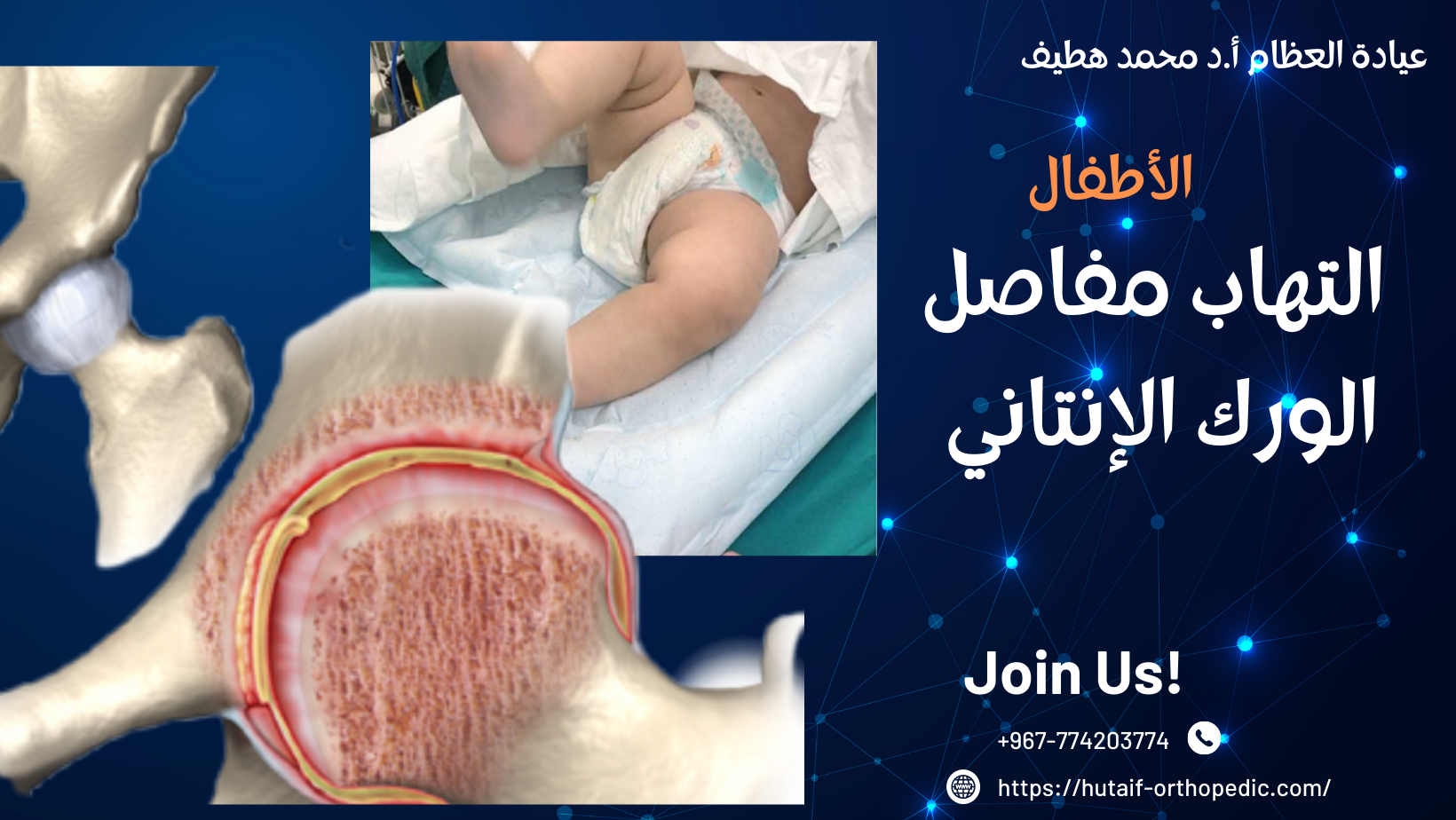 التهاب المفصل الإنتاني الوركي عند الأطفال: ماذا تحتاج إلى معرفته