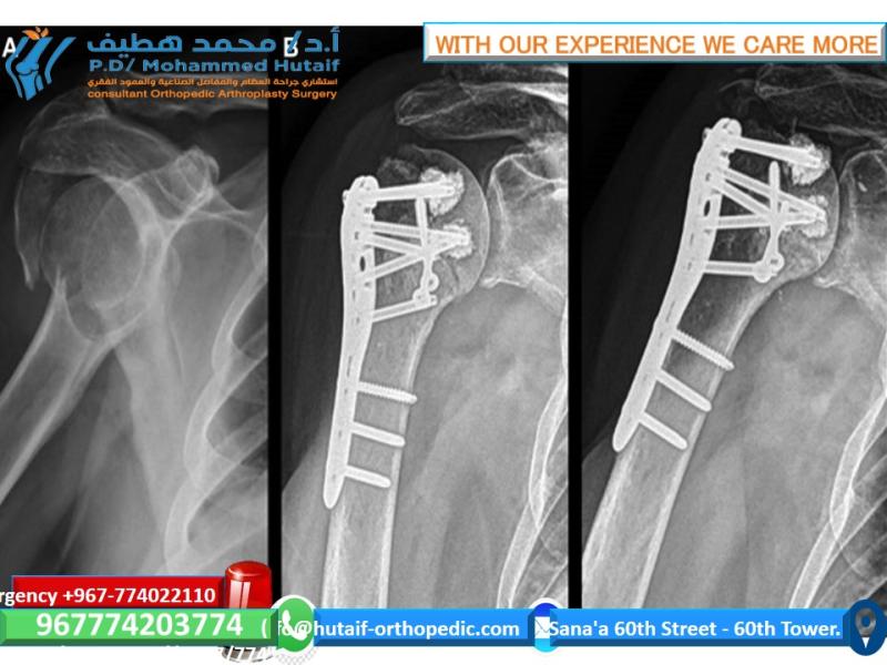 For Doctors Proximal Humeral Fractures, Extra AArticular 2-Part, Surgical Neck, Impaction Treatment ORIF - Plate fixation