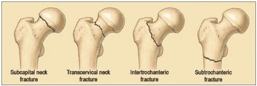 What is the difference between a subcapital and intertrochanteric fracture?