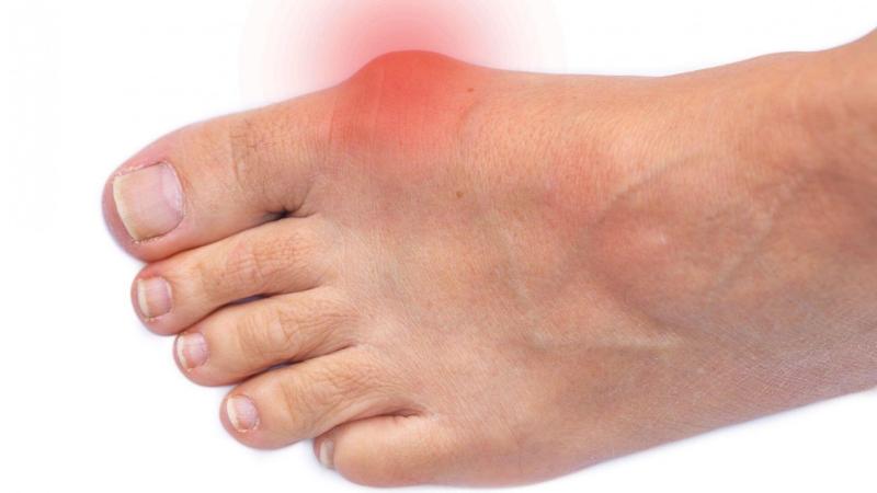 Bunions: What Are They and How to Prevent Them