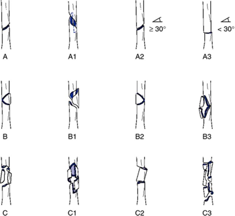 Understanding Femoral Shaft Fractures: Anatomy, Diagnosis, and Treatment