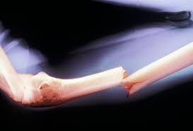 Fractures of the Humerus: Everything You Need to Know