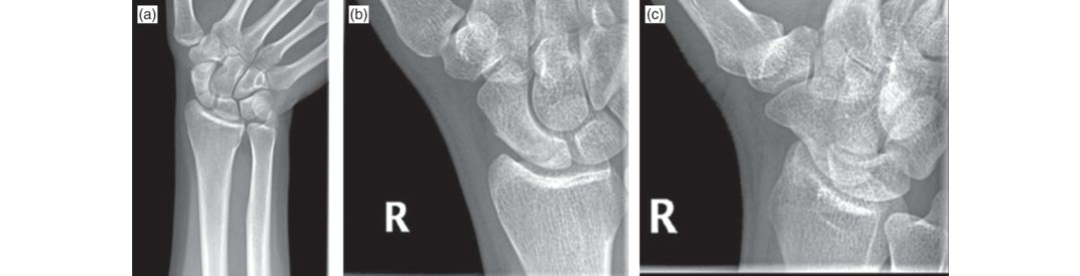 Mastering the Management of Scaphoid Fractures: Understanding Classification, Treatment, and Complications
