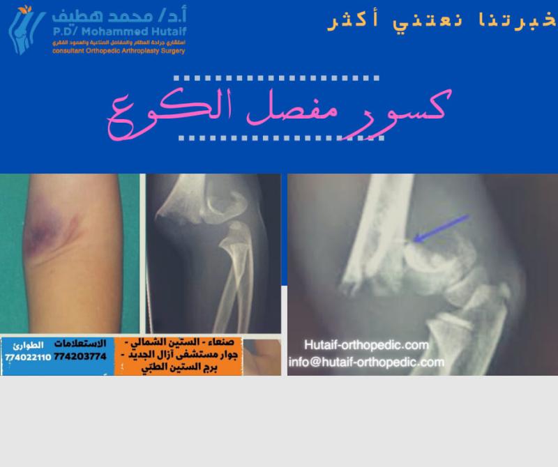 افضل دكتور عظامClosed Reduction and Percutaneous Pinning of Supracondylar Fractures of  the Humerus