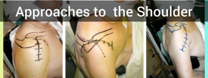 Surgical Approaches to  the Shoulder and Elbow
