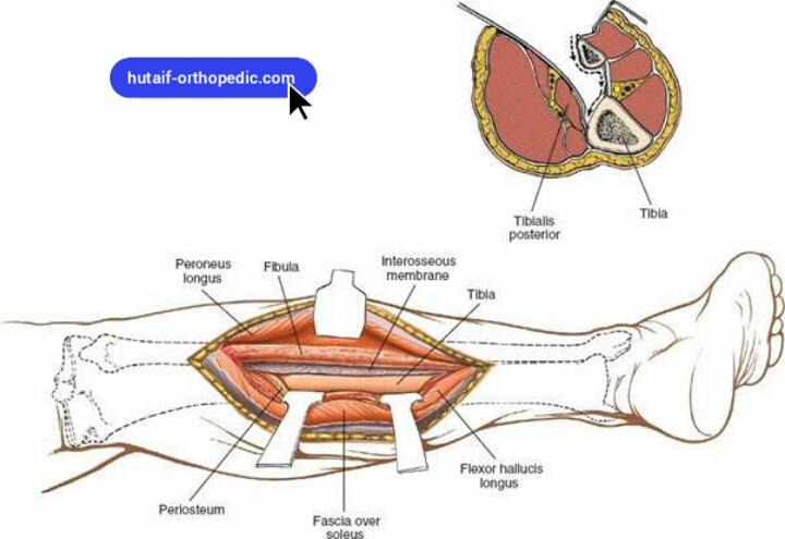Posterolateral Approach to the Tibia