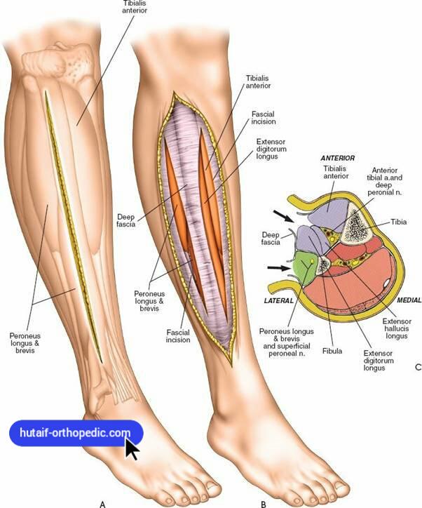Applied Surgical Anatomy of the Leg— Approaches for Decompression of a Compartment Syndrome
