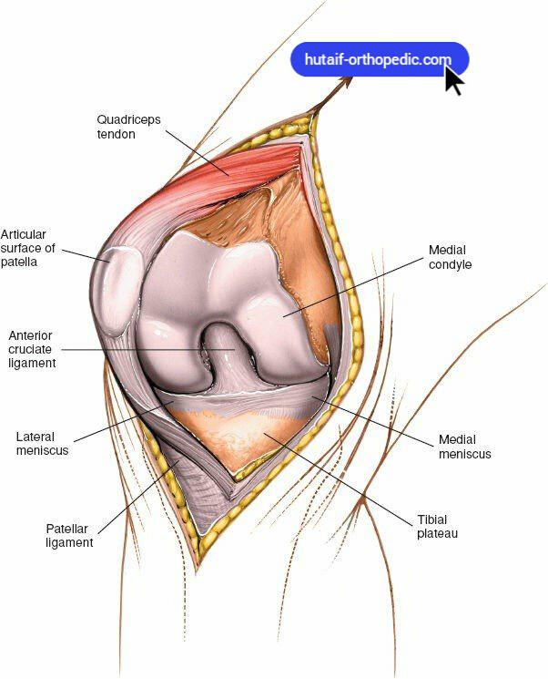 Medial Parapatellar Approach