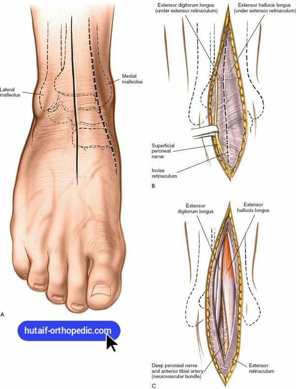 Anterior Approach to the Ankle