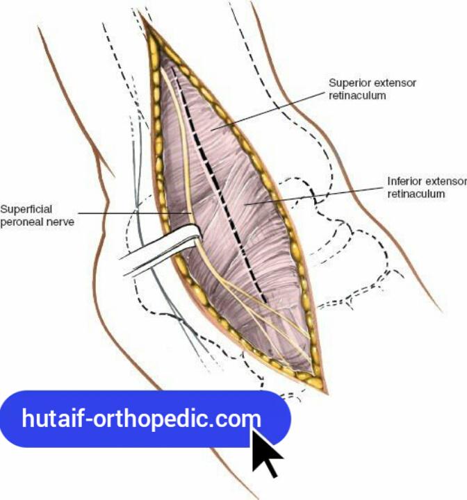 Anterolateral Approach to the Ankle and Hindpart of the Foot