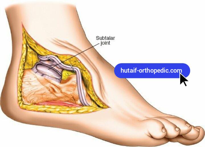 Lateral Approach to the Calcaneus