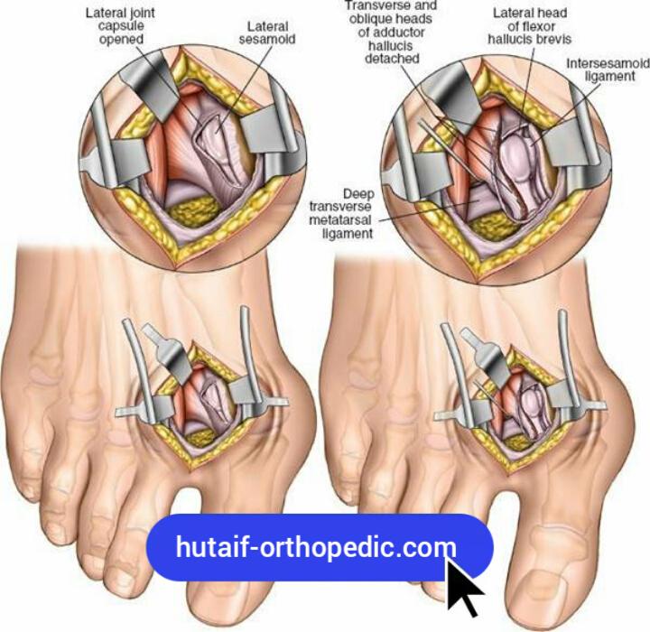 Dorsolateral Approach for Bunion Surgery