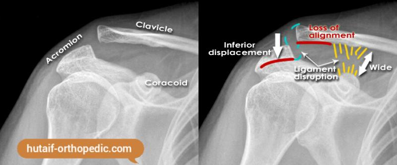 ACROMIOCLAVICULAR DISLOCATION