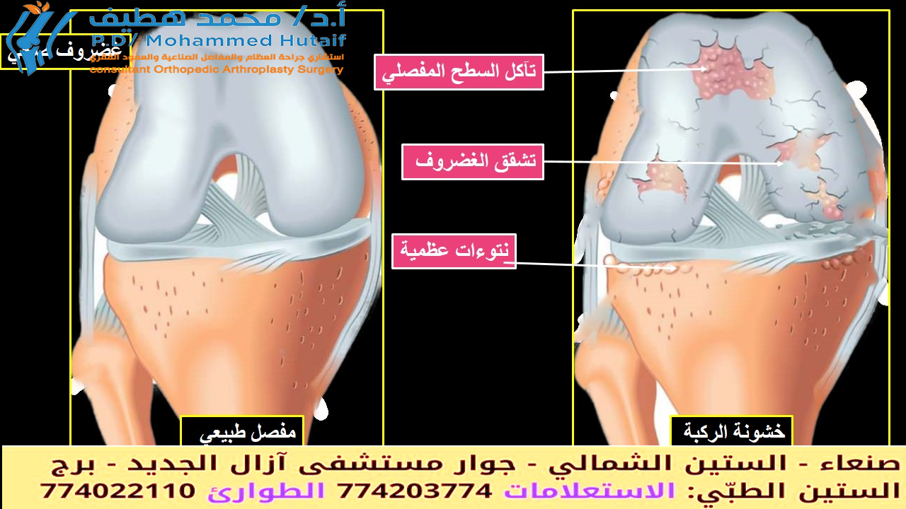 ما هي أسباب خشونة الركبة؟