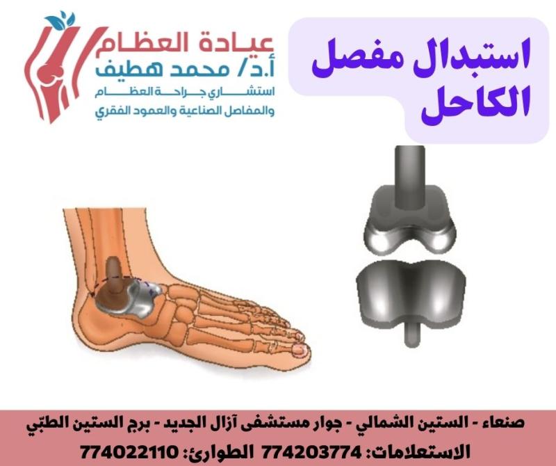 استبدال مفصل الكاحل