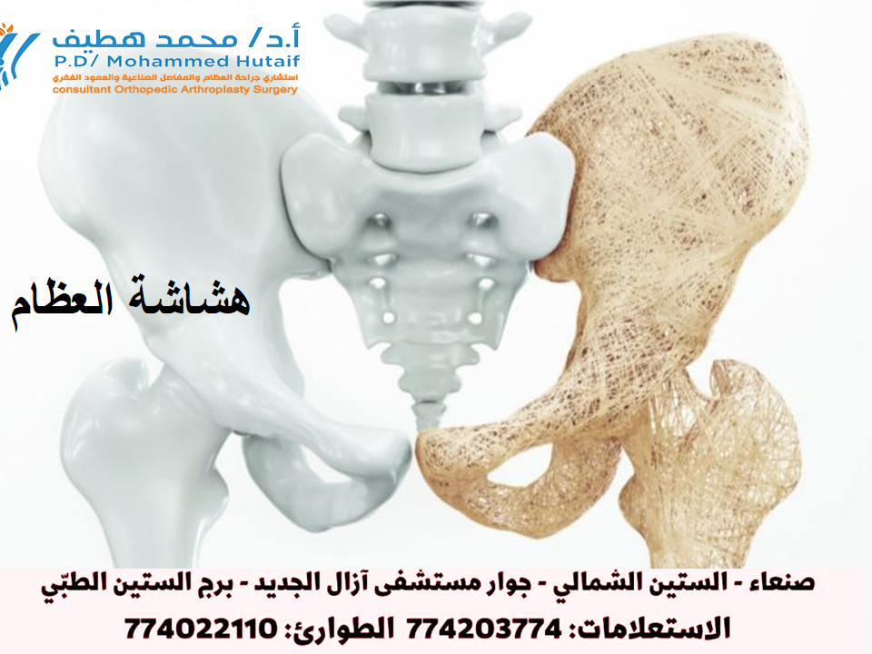  هشاشة العظام-دكتور عظام 