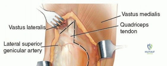 صورة توضيحية لـ بسط العضلة الرباعية بتقنية V-Y: حلول الأستاذ الدكتور محمد هطيف لتعقيدات جراحة الركبة