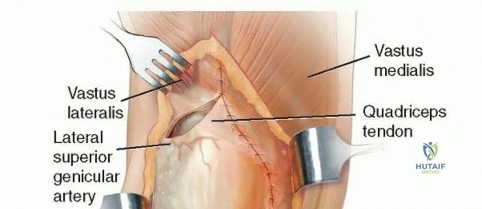 صورة توضيحية لـ بسط العضلة الرباعية بتقنية V-Y: حلول الأستاذ الدكتور محمد هطيف لتعقيدات جراحة الركبة
