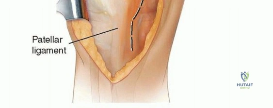 صورة توضيحية لـ بسط العضلة الرباعية بتقنية V-Y: حلول الأستاذ الدكتور محمد هطيف لتعقيدات جراحة الركبة