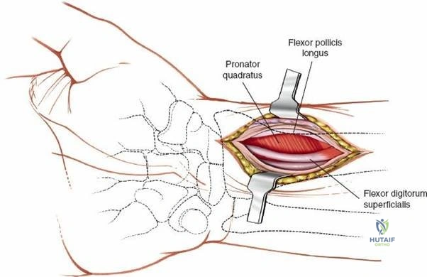 Figure 5-15 Position of the patient for volar approaches to the distal radius.