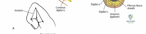 Illustration of flexor tendons volar - Dr. Mohammed Hutaif