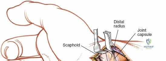 Illustration of scaphoid volar approach - Dr. Mohammed Hutaif