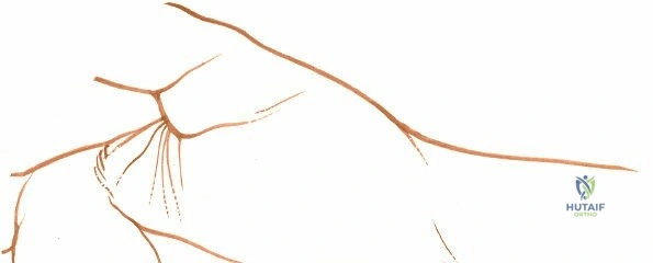 Guyon's Canal Syndrome: Volar Approach for Ulnar Nerve Decompression & Exploration