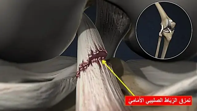 علاج كسور مفصل عنق الفخذ بالشباب: الحفاظ على الدموية لتعافٍ تام.