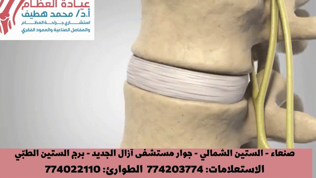 الانزلاق الغضروفي