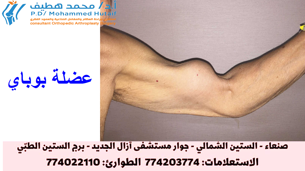 تمزق عضلات الكتف