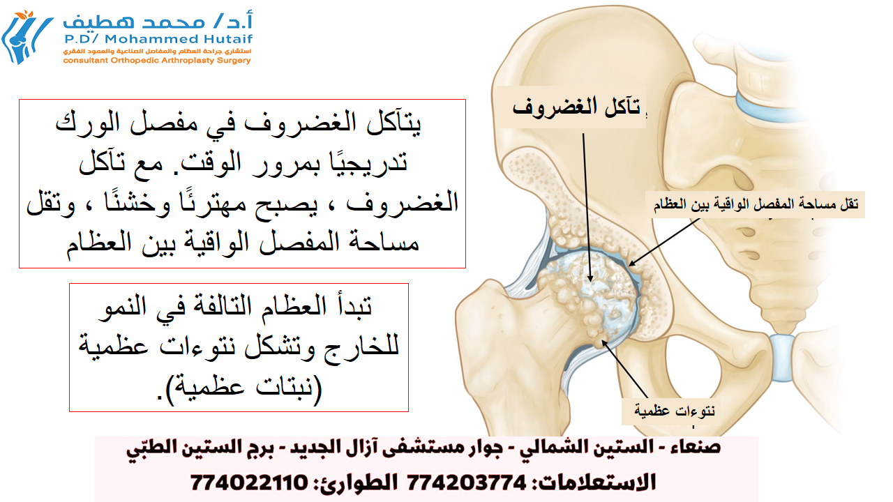 الأسباب الشائعة لآلام الورك السبب الأكثر شيوعًا لألم الورك المزمن والعجز هو التهاب المفاصل. يعد احتكاك المفاصل والتهاب المفاصل الروماتويدي والتهاب المفاصل الرضحي أكثر أشكال هذه المرض شيوعًا.  احتكاك العظام.  هذا هو نوع من التآكل والتهاب المفاصل المرتبط بالعمر. يحدث عادةً عند الأشخاص الذين يبلغون من العمر 50 عامًا أو أكثر، وغالبًا ما يصيب الأفراد الذين لديهم تاريخ عائلي من احتكاك المفاصل. يتآكل الغضروف الذي يبطن عظام الورك. ثم تحتك العظام ببعضها البعض ، مما يسبب ألم الورك وتيبسه. قد يحدث الفُصال العظمي أيضًا بسبب مخالفات دقيقة في كيفية تطور الورك في مرحلة الطفولة. التهاب المفصل الروماتويدي.  هذا هو مرض مناعي ذاتي حيث يصبح الغشاء الزليلي ملتهبًا وسميكًا. يمكن أن يؤدي هذا الالتهاب المزمن إلى تلف الغضروف، مما يؤدي إلى الشعور بالألم والتصلب. التهاب المفاصل الروماتويدي هو النوع الأكثر شيوعًا من مجموعة الاضطرابات المسماة التهاب المفاصل الالتهابي. التهاب المفاصل الرضحي.  هذا يمكن أن يتبع إصابة خطيرة في الورك أو كسر. قد يتلف الغضروف ويؤدي إلى ألم وتيبس الورك بمرور الوقت. تنخر العظم.  قد تؤدي إصابة الورك ، مثل الخلع أو الكسر ، إلى تقييد وصول الدم إلى رأس الفخذ. وهذا ما يسمى تنخر العظم (يشار إليه أحيانًا باسم النخر اللاوعائي). قد يؤدي نقص الدم إلى انهيار سطح العظام، ويؤدي ذلك إلى التهاب المفاصل. يمكن أن تسبب بعض الأمراض أيضًا تنخر العظم. مرض الورك في مرحلة الطفولة.  يعاني بعض الرضع والأطفال من مشاكل في الفخذ. على الرغم من نجاح علاج المشاكل في مرحلة الطفولة، إلا أنها قد تستمر في التسبب في التهاب المفاصل في وقت لاحق من الحياة. يحدث هذا لأن الورك قد لا ينمو بشكل طبيعي ، وتتأثر أسطح المفاصل. الورك مع احتكاك العظام  في التهاب مفاصل الورك، يتآكل الغضروف المفصلي الأملس ويصبح مهترئًا وخشنًا.
