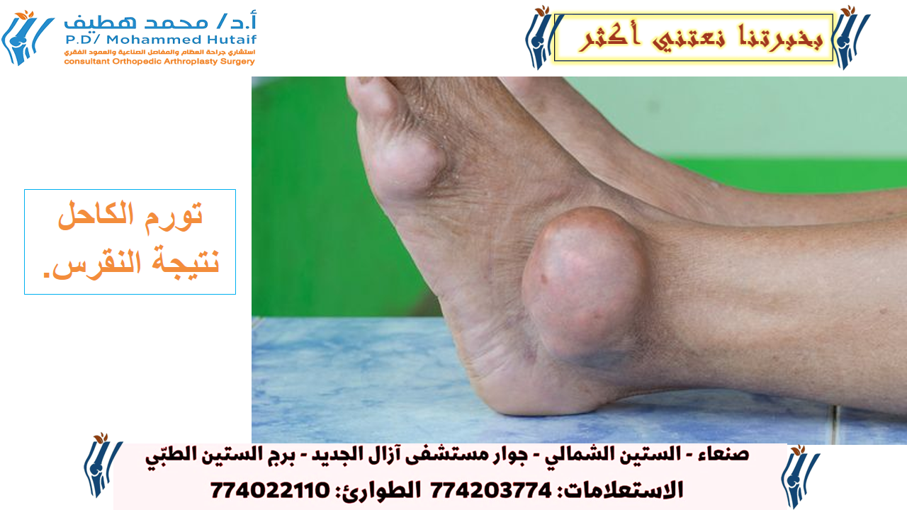 كل شيء عن النقرس -الأعراض والتشخيص والعلاج    عندما يسبب النقرس ألمًا شديدًا في المفاصل ، فإنه يُسمى نوبة النقرس ، أو اندلاع النقرس ، أو النقرس الحاد . عادة ما يكون الألم مصحوبًا بألم شديد في المفاصل وتورم ودفء واحمرار في الجلد. قد تظهر الأعراض فجأة ودون سابق إنذار.  يقدر الخبراء أن النقرس سيؤثر على 4٪ من الأشخاص خلال حياتهم ، وغالبًا ما يحدث عند الرجال والأشخاص فوق سن الستين . عادةً، يتأثر مفصل واحد فقط في كل مرة ، ولكن من الممكن أن تتأثر عدة مفاصل أثناء نوبة النقرس.  المفاصل المتضررة من النقرس يمكن أن يؤثر النقرس على أي مفصل ، ولكن من المرجح أن تتأثر بعض المفاصل أكثر من غيرها. تشمل المفاصل المصابة بشكل شائع إصبع القدم الكبير ومشط القدم والكعب والكاحل والركبة. في كثير من الأحيان ، يؤثر النقرس على الكوع أو الرسغ أو أطراف الأصابع أو العمود الفقري.  تورم الكاحل نتيجة النقرس. النقرس عبارة عن انتفاخ حاد ومؤلم في المفاصل نتيجة تراكم حمض البوليك. تشمل المناطق المشتركة القدم وإصبع القدم الكبير.  الفروق بين الرجل والمرأة تلعب الفروق بين الجنسين دورًا في إصابة المفاصل:  عند الرجال ، يصيب حوالي 85٪ من نوبات احتدام النقرس المفاصل في الأطراف السفلية. تتضمن حوالي 50٪ من نوبات النقرس لأول مرة مفصل إصبع القدم الكبير.  عند النساء ، من المرجح أن تحدث نوبة النقرس في الركبة. بالإضافة إلى ذلك ، قد تكون النساء أكثر عرضة للإصابة بالنقرس في الأطراف العلوية.  في حين أن النساء أقل عرضة للإصابة بالنقرس ، فمن المرجح أن يكون لديهن مفاصل متعددة متأثرة بالنقرس.    كيف تتطور نوبة النقرس ينتج النقرس عن تراكم بلورات حمض اليوريك (بلورات بولات أحادية الصوديوم) في المفصل. تتجمع هذه البلورات المجهرية التي تشبه الإبرة في الأنسجة الرخوة للمفصل ، مما يتسبب في ألم يمكن أن يكون مؤلمًا ، بالإضافة إلى التورم والاحمرار والدفء.  كيف تتشكل بلورات حمض اليوريك يبدأ تراكم بلورات حمض اليوريك بالبيورينات ، وهو مركب كيميائي يوجد في العديد من الأطعمة.  عندما يستقلب الجسم البيورينات ، فإنه ينتج مادة تسمى حمض البوليك . يدخل حمض البوليك إلى مجرى الدم. تقوم الكلى بترشيح الدم وتصفية حمض البوليك الزائد بشكل طبيعي. ثم يُفرز حمض البوليك هذا عن طريق البول (70٪) أو البراز (30٪).  إذا لم تتمكن الكلى من تصفية حمض البوليك الزائد بشكل كافٍ ، أو إذا كان الجسم ينتج الكثير من حمض البوليك ، فسيكون هناك الكثير من حمض البوليك في مجرى الدم. يسمى الكثير من حمض اليوريك في مجرى الدم بفرط حمض يوريك الدم . يؤدي فرط حمض يوريك الدم لدى بعض الأشخاص إلى تكوين بلورات حمض اليوريك التي تتجمع في أنسجة المفاصل ، مما يؤدي إلى ظهور أعراض مؤلمة. يؤدي عدم القدرة على معالجة وإفراز حمض البوليك بشكل كافٍ إلى ما يقدر بنحو 90٪ من حالات النقرس. تحدث حالات أخرى لأن الجسم ينتج الكثير من حمض البوليك.   في هذا المقال: كل شيء عن النقرس - الأعراض والتشخيص والعلاج أعراض النقرس أسباب النقرس وعوامل الخطر تشخيص النقرس علاج النقرس منع النقرس لماذا يحدث التوهج في الليل من المرجح أن تبدأ نوبات النقرس في منتصف الليل ، مما يؤدي إلى إيقاظ الشخص من نوم عميق. وجدت إحدى الدراسات البحثية التي أجريت على أكثر من 700 مريض بالنقرس أن احتمالية حدوث النوبات كانت 2.4 مرة بين منتصف الليل والساعة 8 صباحًا مقارنةً بين الساعة 8 صباحًا و 4 مساءً.   يعتقد الباحثون أن نوبات النقرس تحدث غالبًا في الليل للأسباب التالية:  من المرجح أن يشكل حمض اليوريك بلورات في درجات حرارة منخفضة. تنخفض درجة حرارة الجسم قليلاً أثناء النوم ، مما يشجع على تكوين البلورات.  تتباطأ معدلات التنفس أثناء النوم ، وتخرج الرئتان كمية أقل من ثاني أكسيد الكربون. يمكن أن يتسبب ثاني أكسيد الكربون الزائد في زيادة حمضية الدم قليلاً. هذه الحالة ، التي تسمى الحماض التنفسي ، قد تشجع على تكوين بلورات حمض اليوريك.  يستهلك الأشخاص المصابون بانقطاع التنفس أثناء النوم كمية أقل من الأكسجين ، مما قد يؤدي إلى زيادة إنتاج الجسم من البيورينات ويسبب فرط حمض يوريك الدم.  تميل مستويات الكورتيزون في الجسم إلى الانخفاض أثناء النوم. يمنع الكورتيزون الالتهاب ، وقد يساهم الانخفاض في الكورتيزون في التهاب النقرس.  قد يؤدي الجفاف الليلي إلى تسهيل فرط حمض يوريك الدم و / أو زيادة تركيز البلورات في سائل المفصل.  المزيد من البحث مطلوب في هذه المنطقة.   هجوم نوبة النقرس مقابل النقرس المزمن من الممكن أن تصاب بنوبة النقرس ولا تعاني من نوبة أخرى. تسمى الحالات المتكررة للنقرس الحاد بالنقرس المزمن  .  تختلف أهداف علاج نوبة النقرس عن أهداف علاج النقرس المزمن. عند علاج نوبة النقرس ، يكون الهدف هو تخفيف الألم والالتهاب. عند علاج النقرس المزمن ، يكون الهدف هو منع نوبات النقرس المستقبلية وتلف المفاصل طويل المدى.  في حين أن بعض الأشخاص المصابين بالنقرس المزمن قد يصابون بنوبات النقرس المتكررة ، قد يمر آخرون بسنوات بين النوبات. إذا لم يتم علاج النقرس المزمن ، فقد تصبح النوبات أكثر تكرارًا و / أو تستمر لفترة أطول.  إذا تُركت نوبة النقرس دون علاج ، فإنها عادة ما تحل نفسها في غضون أيام أو أسابيع قليلة. يمكن أن يؤدي النقرس المزمن إلى إتلاف أنسجة المفصل بشكل دائم وتقليل نطاق حركته. لهذا السبب ، من المهم التعرف على الأعراض وفهم عوامل الخطر والحصول على تشخيص دقيق وعلاج النقرس والوقاية منه.    الصفحة التالية: أعراض النقرس