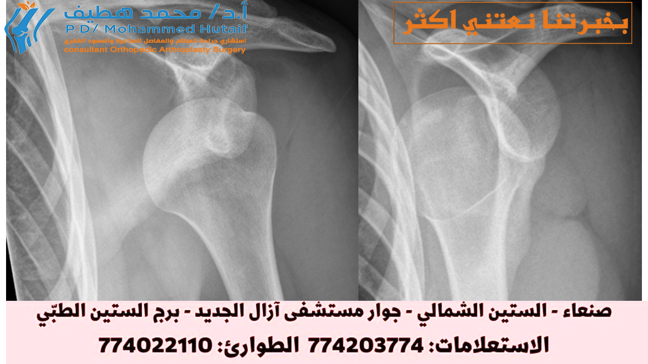 فحص الطبيب احصل على مساعدة طبية على الفور في حالة وجود خلع في الكتف.  أثناء انتظارك للعناية الطبية:  لا تحرك المفصل. جبيرة أو حمالة مفصل الكتف في وضعه الحالي. لا تحاول تحريك الكتف أو إجباره على العودة إلى مكانه. يمكن أن يؤدي ذلك إلى تلف مفصل الكتف والعضلات أو الأربطة أو الأعصاب أو الأوعية الدموية المحيطة به. ضع ثلجًا على المفصل المصاب. يمكن أن يساعد وضع الثلج على كتفك في تقليل الألم والتورم عن طريق التحكم في النزيف الداخلي وتراكم السوائل في مفصل الكتف وحوله. قد يكون للعضلات تقلصات بسبب الخلع ، وهذا يمكن أن يزيد الألم. عندما ينخلع الكتف مرارًا وتكرارًا ، يكون هناك عدم استقرار متكرر في الكتف.  سيفحص طبيبك الكتف وقد يطلب أشعة سينية. من المهم أن يعرف طبيبك كيف حدث الخلع وما إذا كان الكتف قد خلع من قبل. لتحضير لموعدك اعتمادًا على شدة الإصابة ، قد يوصي طبيب الأسرة أو طبيب غرفة الطوارئ بأن يقوم جراح العظام بفحص الإصابة.  ما تستطيع فعله قد ترغب في تدوين ما يلي:  وصف تفصيلي للأعراض والحدث المُسبب؟ معلومات حول المشاكل الطبية السابقة جميع الأدوية والمكملات الغذائية التي تتناولها أسئلة تريد طرحها على الطبيب بالنسبة لخلع الكتف ، قد تتضمن بعض الأسئلة الأساسية ما يلي:  هل خلع كتفي؟ ما الاختبارات التي أحتاجها؟ ما هو نهج العلاج الذي توصي به؟ هل توجد بدائل؟ كم من الوقت سيستغرق كتفي للشفاء؟ هل سيتعين علي التوقف عن المشاركة في الرياضة؟ إلى متى؟ كيف يمكنني حماية نفسي من تكرار إصابة كتفي؟ ماذا تتوقع من طبيبك قد يطرح عليك طبيبك أسئلة ، مثل:  كيف أصبت كتفك؟ ما مدى شدة ألمك؟ ما هي الأعراض الأخرى التي لديك؟ هل تستطيع تحريك ذراعك؟ هل هناك في ذراعك خدر أو وخز؟ هل خلعت كتفك من قبل؟ ما الذي يبدو أنه يحسن أعراضك ، إن وُجد؟ ماذا، إذا كان هناك أي شيء، يبدو أنة يفاقم الأعراض الخاصة بك؟ مقالات ذات صلة كسر الترقوة (كسر الترقوة) اضطرابات المفصل القصي الترقوي (SC) تمزق وتر العضلة ذات الرأسين عند الكتف تمارين إعادة تأهيل الكفة والكتف الصفحة التالية: العلاج
